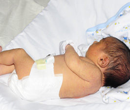 La dermatitis del pañal